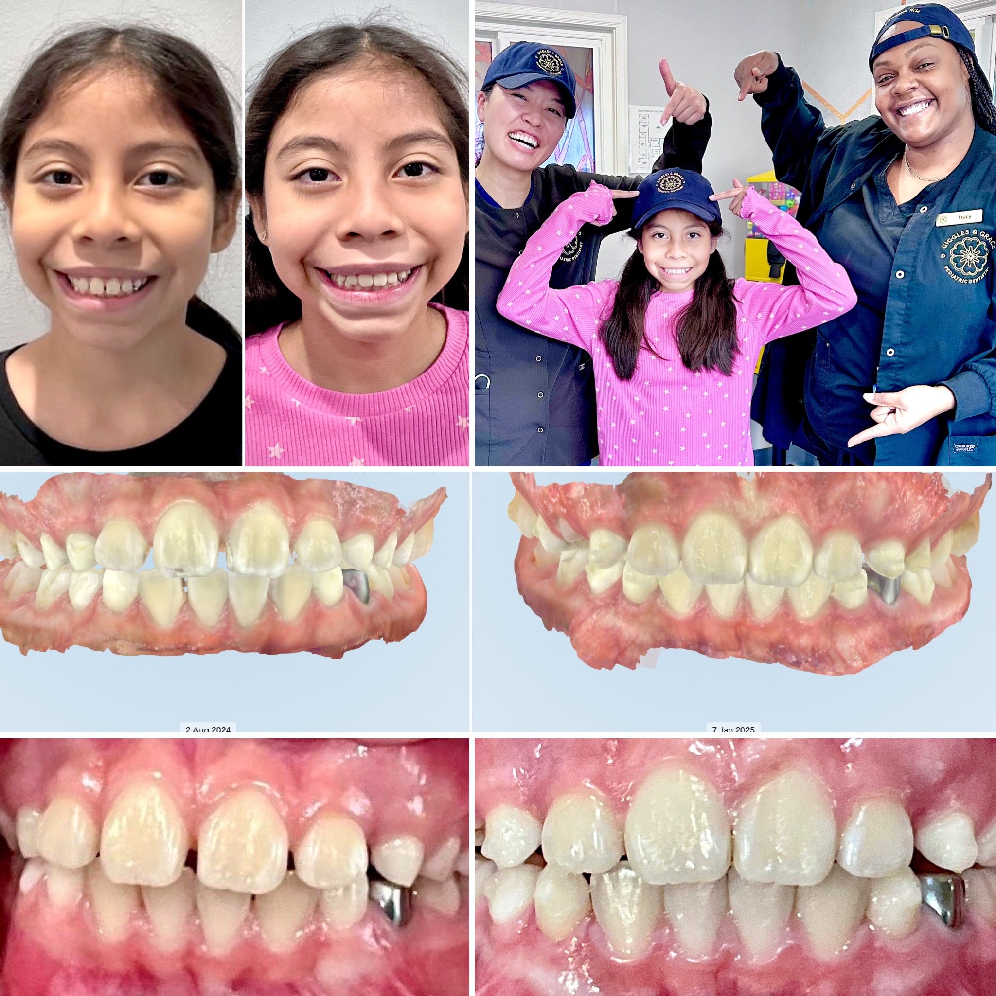 Child's smile showing 5-month Invisalign progress at Giggles & Grace